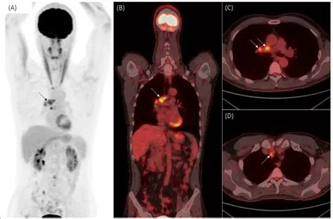 What Causes Lymph Nodes to Light Up on PET Scan and Why Do They Sometimes Glow Like Fireflies in the Dark?